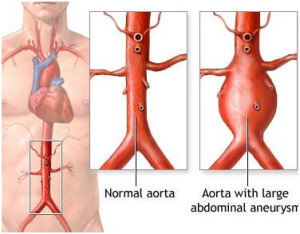 aneurisma